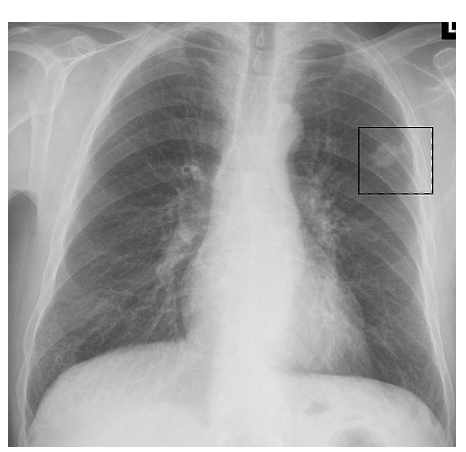 lung carcinoma