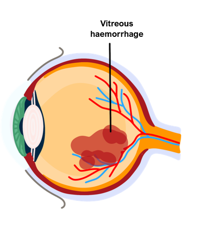 vitreous haemorrhage