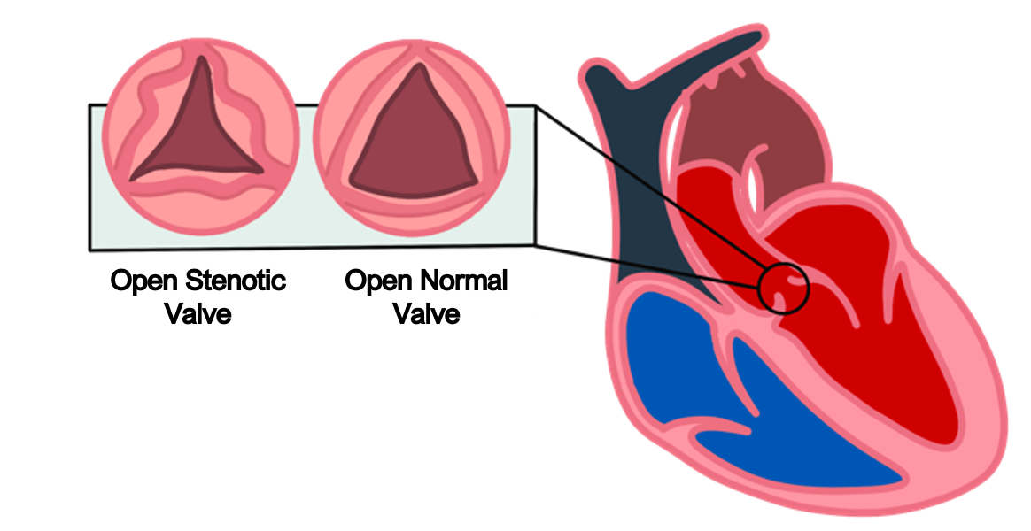 mitral stenosis