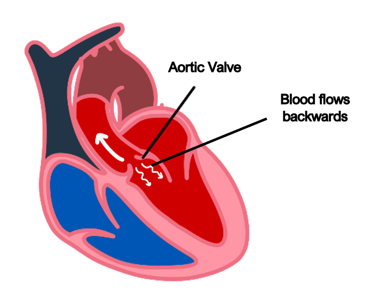 mitral stenosis